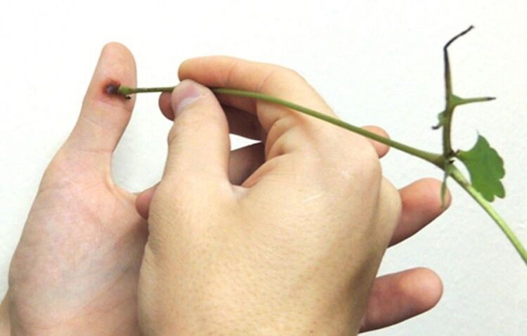 eliminación de una verruga en un dedo con jugo de hierba celidonia