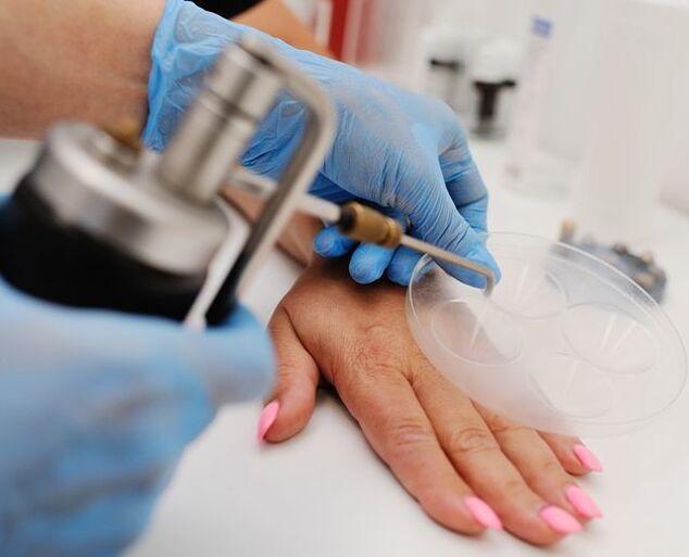 Criodestrucción un método para eliminar las verrugas de las manos mediante congelación con nitrógeno líquido. 